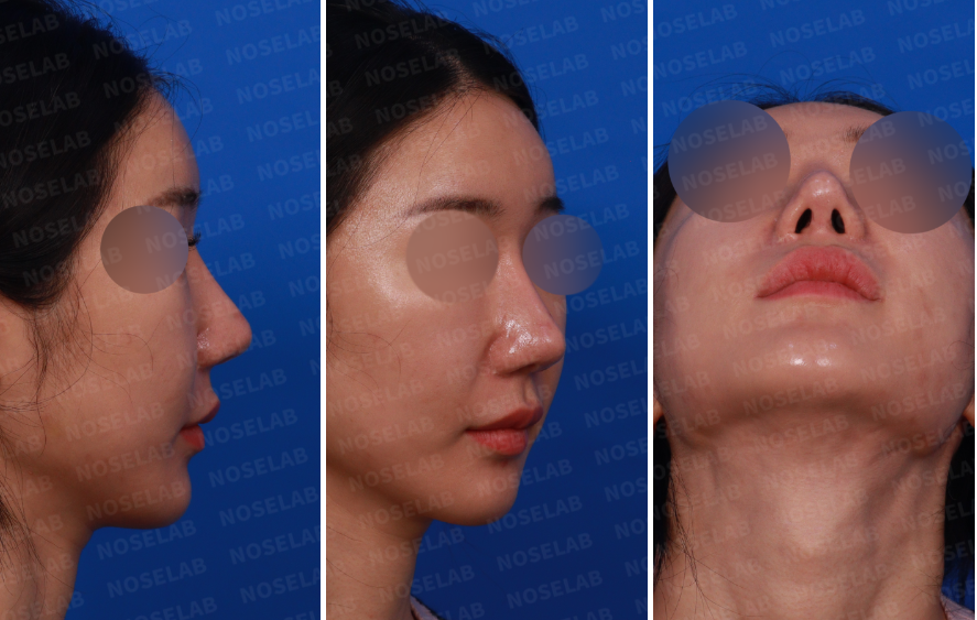 Preoperative design consultation photos showing right side profile, right oblique 45-degree angle, and nostril view before nostril reconstruction surgery (closed rhinoplasty)