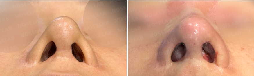 Rhinoplasty for long mid-face correction – before (left) and after (right) nostril view photos