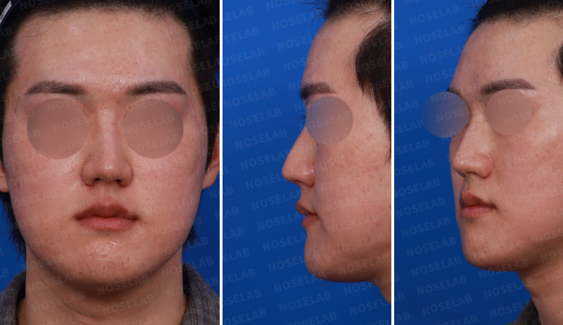 Preoperative design consultation photos of a male patient: frontal view, left oblique view, and left side view before implant-free closed rhinoplasty