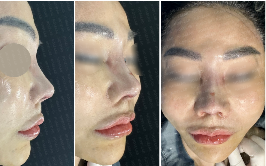 Immediate postoperative photos after nasal contracture correction, including side profile, 45-degree oblique, and frontal view