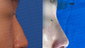 Closed Rhinoplasty Korea Hump and Bulbous Nose before and after side view – showing refined nasal line and balanced profile after closed rhinoplasty by Dr. Cha-Young Kang