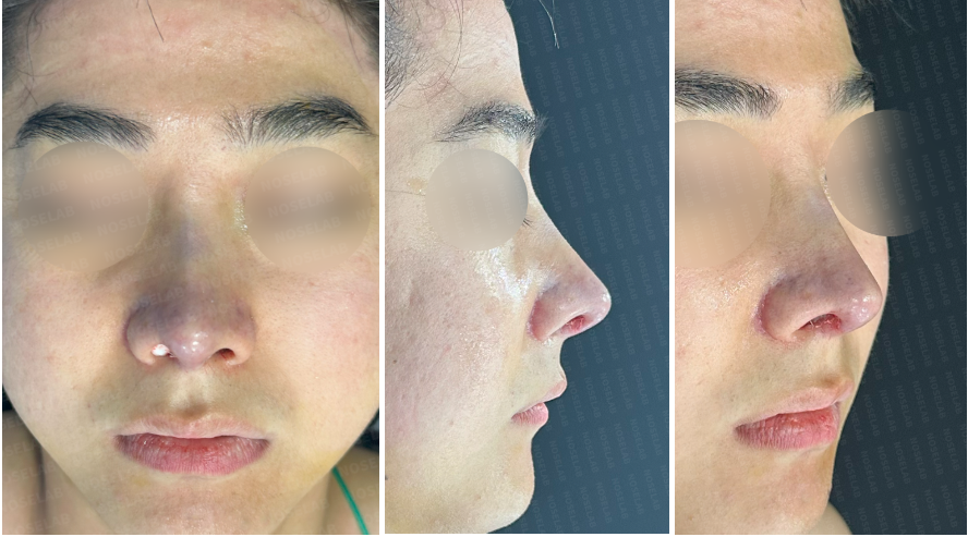 Immediately after Short and Low Nasal Bridge Rhinoplasty: combined frontal, side, and oblique views showing elevated nasal bridge, refined tip shape, and improved overall facial harmony.