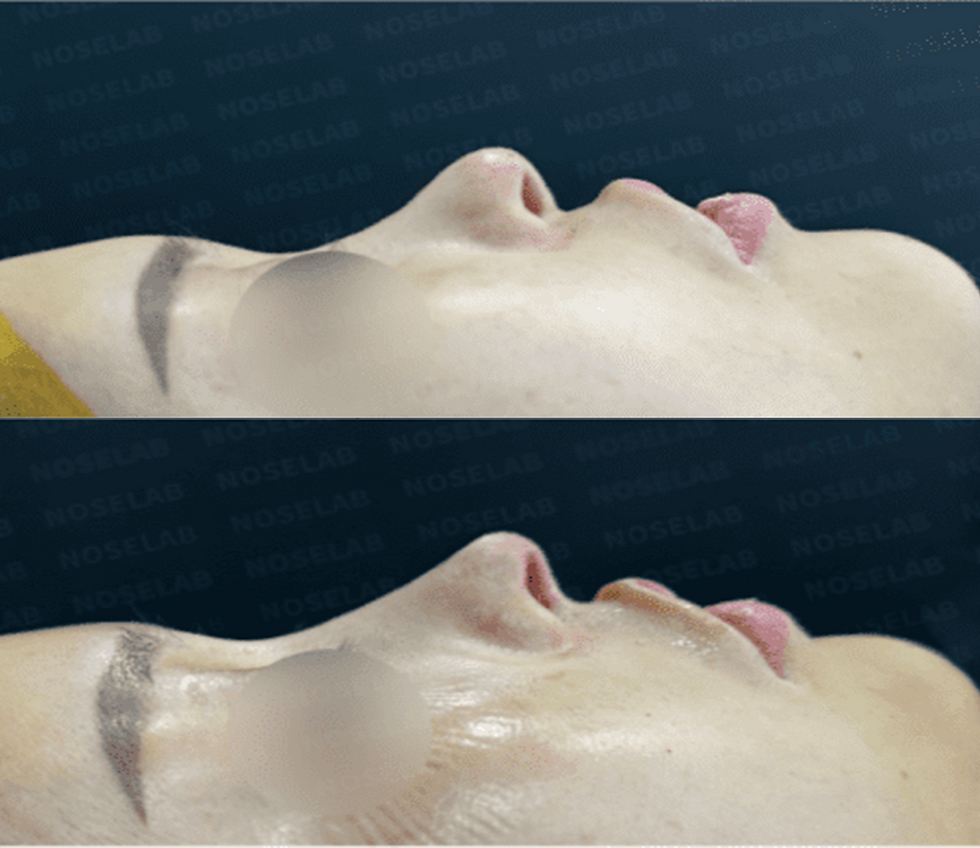 Before and after rhinoplasty photos for contracted and upturned nose correction using autologous rib cartilage
