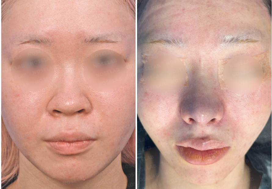 Before and immediately after frontal comparison showing refined and narrowed nasal tip after bulbous nose correction surgery.