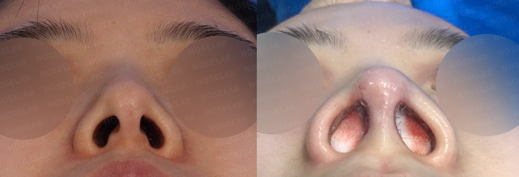 Basal view comparison demonstrating columella alignment and nostril symmetry following comprehensive nasal correction