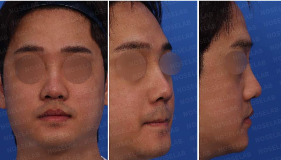 Preoperative design consultation photos, frontal view, oblique view, and side profile.