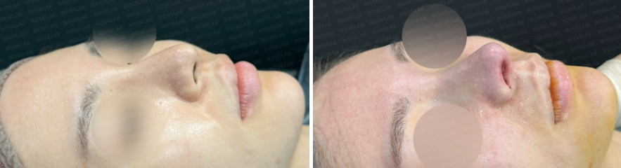 45-degree oblique view before and after rhinoplasty, showing natural lengthening and refined nasal contour.