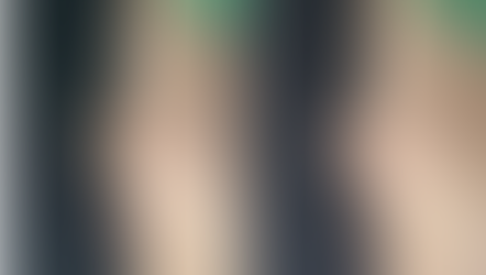 Before and immediately after Upturned Nose Correction – side view comparison showing natural nasal tip rotation and reduced nostril exposure after Medpor removal and septal reconstruction.