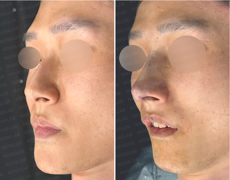 Oblique view photos before (left) and immediately after (right) surgery showing dorsal hump correction and nasal tip refinement using a customized 3D-printed implant.