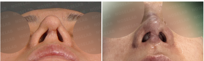 Nostril before and immediately after views showing rib cartilage revision rhinoplasty Korea with improved columellar support and nasal base balance.