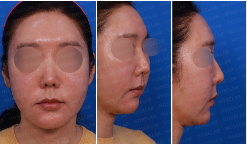 Preoperative photos before revision rhinoplasty: frontal view, 45-degree side view, and full side view showing dorsal hump, nasal deviation, and nostril exposure