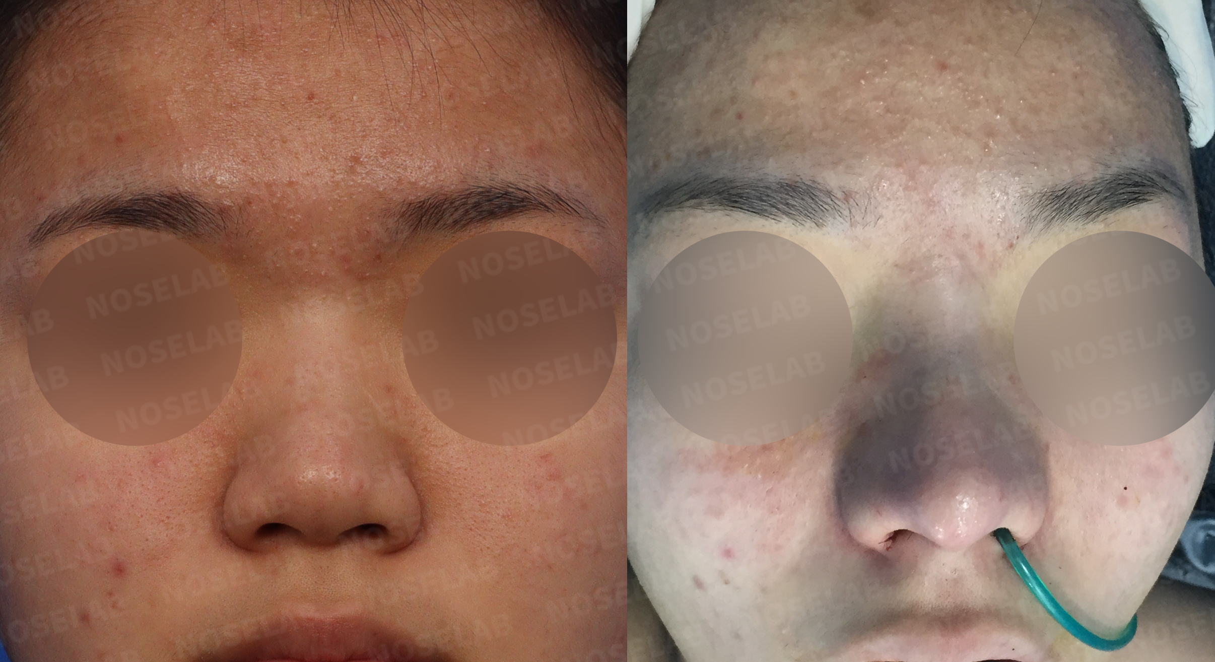 Frontal view results showing improved nasal proportions and symmetry after comprehensive rhinoplasty