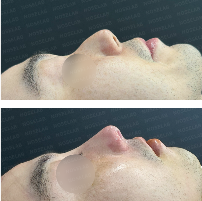 Before and after side profile photos showing Deviated Nose Correction, with improved nasal alignment and natural contour.