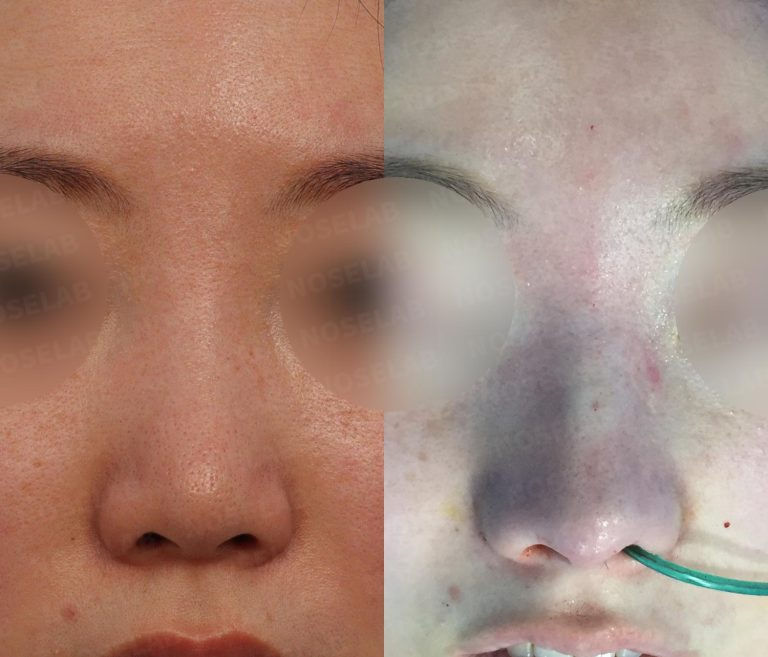 Bulbous nose correction