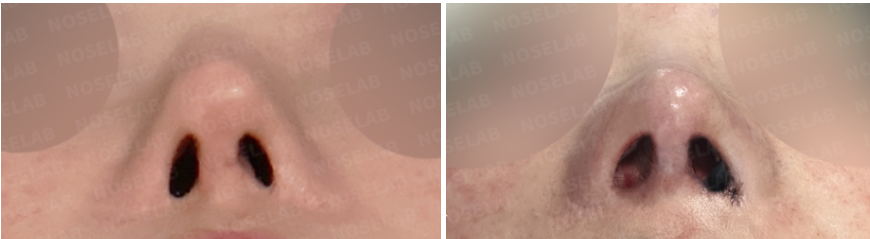 Before and immediately after surgery nostril view comparison showing improved nostril symmetry and restored internal nasal support following septal reconstruction in revision rhinoplasty.