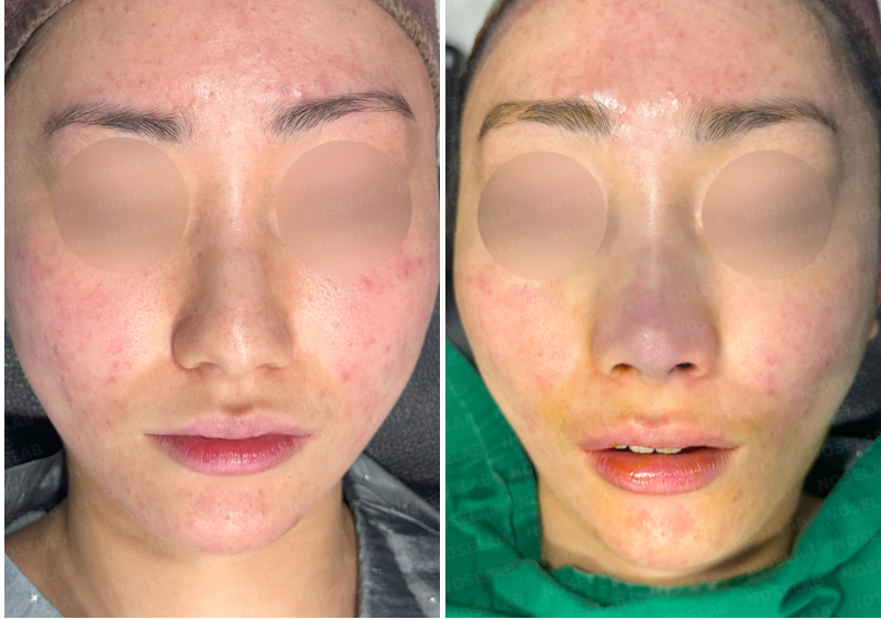 Front view comparison before and after closed rhinoplasty surgery in Korea – patient with crooked nose and bulbous tip correction using rib cartilage graft.