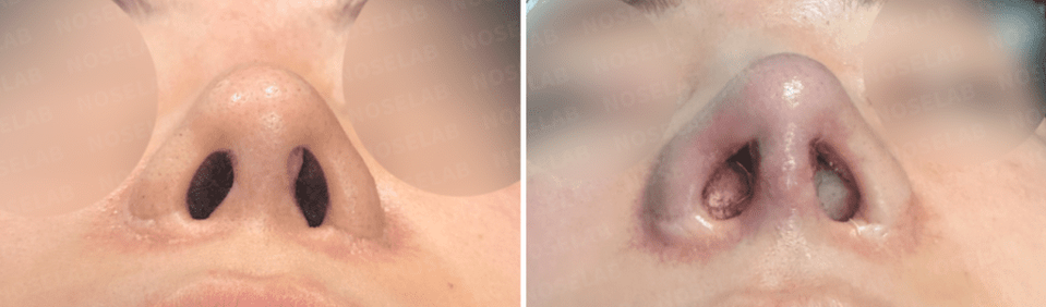 Nostrils before surgery (left) after surgery (right)