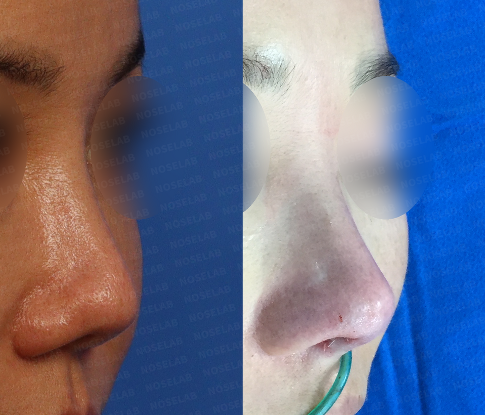 Closed Rhinoplasty Korea Mild Contracted Blunt Nose before and after 45-degree view – enhanced nasal tip projection and refined bridge contour using self rib cartilage by Dr. Cha-Young Kang, NoseLab Clinic