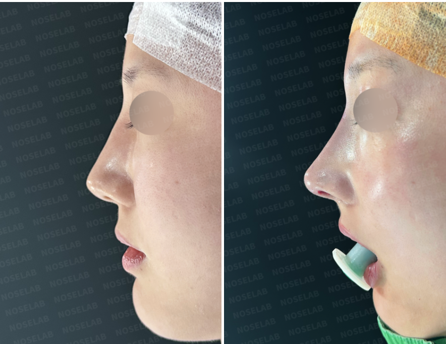 Before and immediately after surgery lateral view showing removal of the dorsal hump and straightening of the nasal bridge following revision closed rhinoplasty with lateral osteotomy and autologous rib cartilage.
