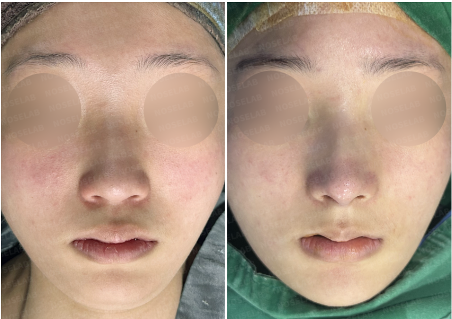 Before and immediately after surgery frontal view showing elevation of the drooping nasal tip, correction of dorsal irregularity, and improved nasal symmetry following closed rhinoplasty with rib cartilage reconstruction and osteotomy.