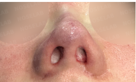 Immediately after surgery – nostril view showing corrected asymmetry and reconstructed columella using autologous rib cartilage.