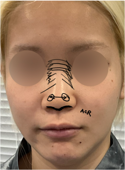 Frontal preoperative design photo showing blunt bulbous nose, wide nasal base, and asymmetrical nostrils.