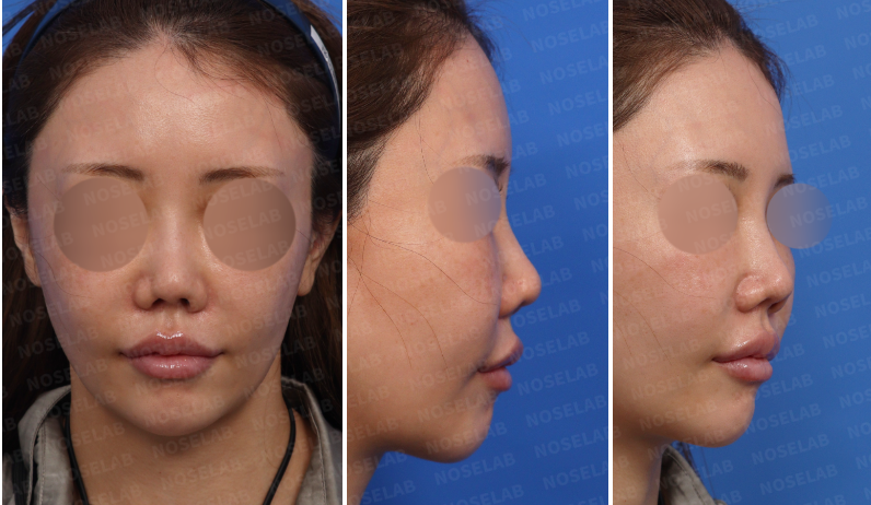 Preoperative design consultation, frontal view, 45-degree view and side profile view.