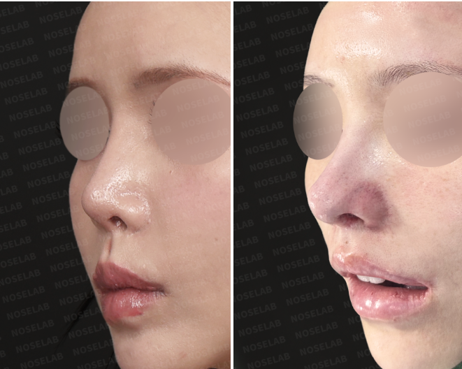 Oblique before and immediately after views showing nasal tip lengthening and rib cartilage septal reconstruction.