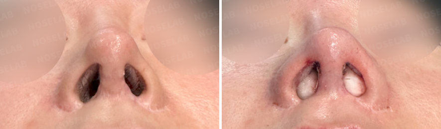 Before and after photos of Upturned Nose Correction surgery: nostril view comparison (Left: before surgery, Right: immediately after surgery).