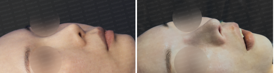 Revision rhinoplasty for short upturned nose – before and after oblique view photos