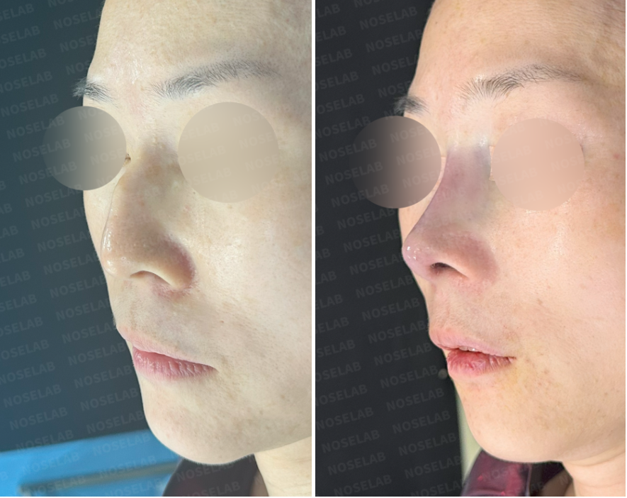 Oblique side profile comparison before and after rhinoplasty – correction of calcified silicone implant and nasal deviation using autologous rib cartilage.