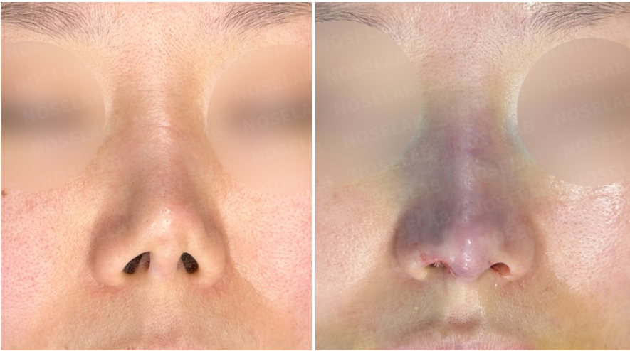 Before (left) and immediately after (right) contracted nose correction with rib cartilage – frontal nostril view showing corrected nostril asymmetry, improved columella alignment, and natural alar contour.
