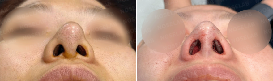 Basal (nostril) view before and immediately after revision rhinoplasty showing improved nostril symmetry, corrected columella position, and enhanced nasal airway opening