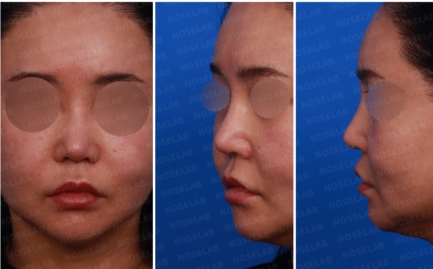 Frontal, oblique, and side view photos before nasal septum reconstruction surgery
