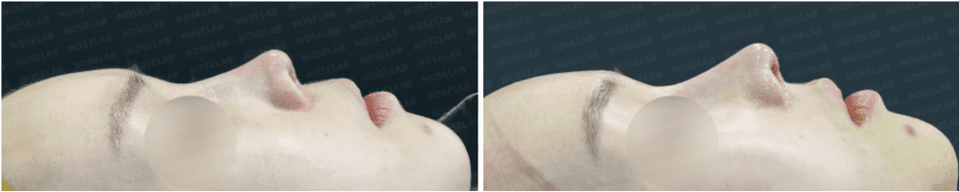 Photos were taken immediately before and after the surgery with the consent of the patient.