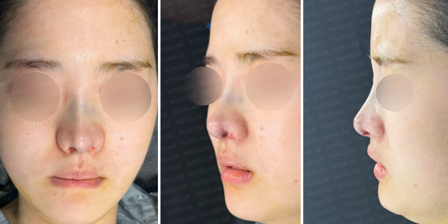 Correcting Nostril Stenosis – Immediately after revision rhinoplasty, frontal, oblique side, and side view showing improved nasal symmetry and structure.