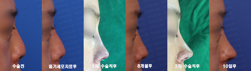 Side view comparison of skin necrosis and contracted nose repair using autologous rib cartilage — pre-op, post stem cell treatment, first surgery, 8 months later, second surgery, and 10 days after operation at NoseLab Seoul.