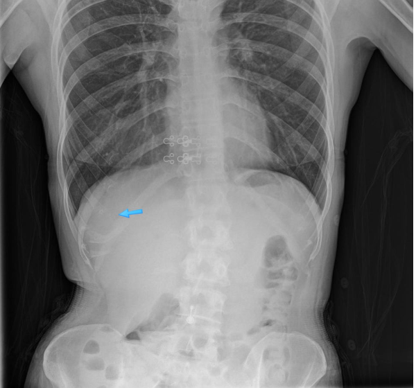 Corrective rhinoplasty after nostril reduction – chest X-ray showing donor rib cartilage marked for harvesting