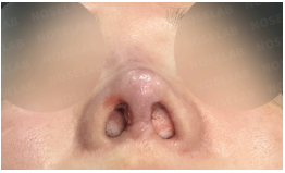 Immediately after complex revision rhinoplasty – nostril/base view of female patient