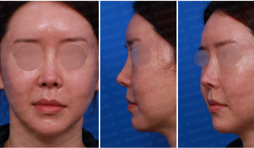 Pre-surgery design consultation photos for Upturned Nose Correction: frontal, left side, and left oblique side views.