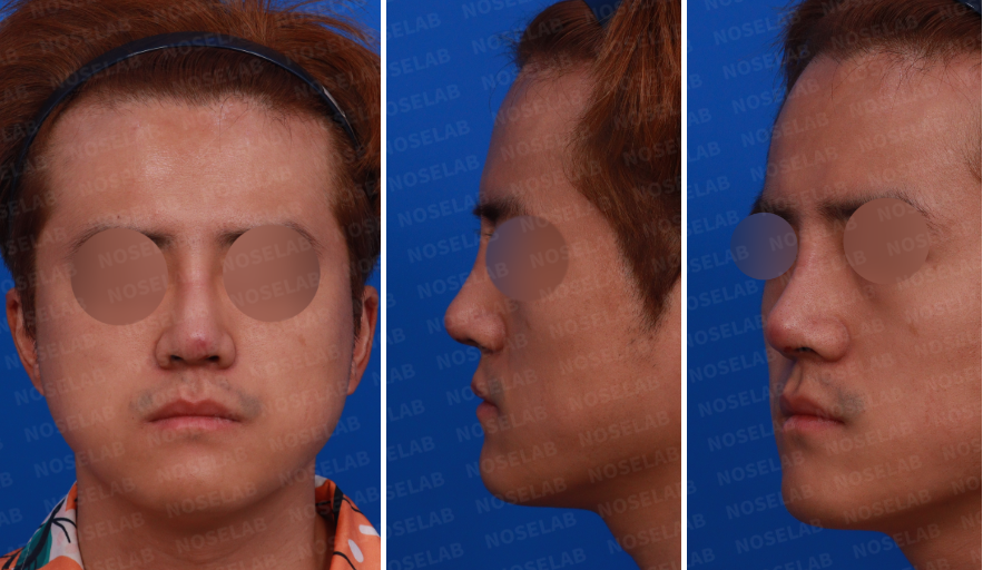 preoperative frontal, oblique, and side views of silicone exposure rhinoplasty case showing nasal inflammation, swelling, and implant-related deformity before closed rhinoplasty Korea