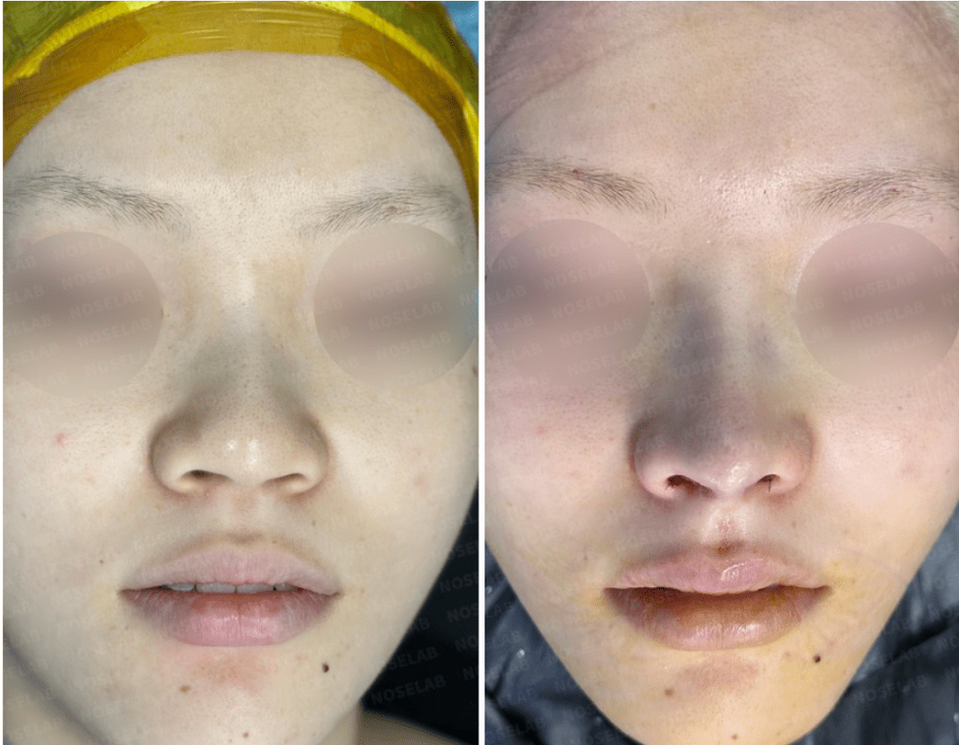 Frontal before-and-after photos showing correction of crooked nose, reduced wide nasal base, and improved nostril symmetry after blunt nose correction.