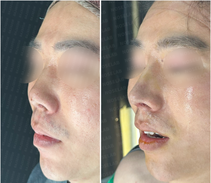 Before and immediately after oblique side view showing improved nasal projection, tip reconstruction, and nostril symmetry correction