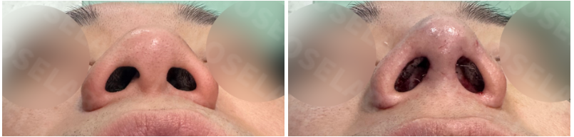 Before and after bulbous nose correction – nostril view showing improved asymmetry and reduced wide nasal base