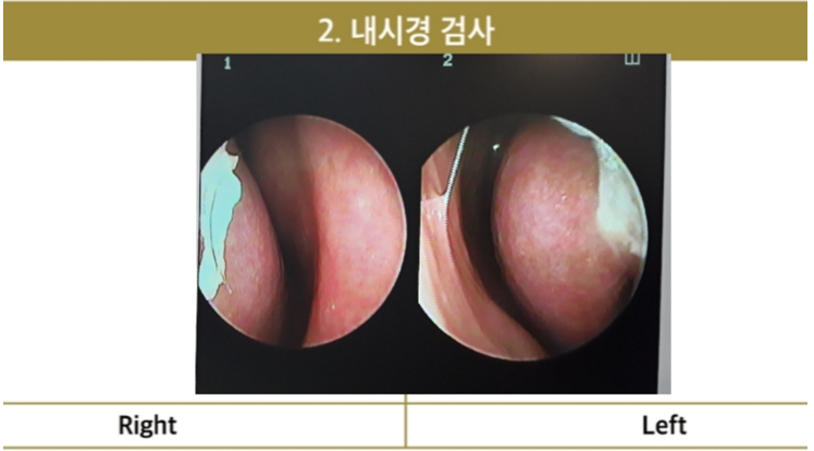 Nasal endoscopy examination photos showing deviated septum and turbinate condition before rhinoplasty for upturned nose and nasolabial angle correction.