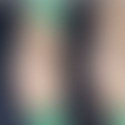 Side view before and after illegal filler removal and total septal reconstruction using autologous rib cartilage — showing improved nasal alignment and natural contour.