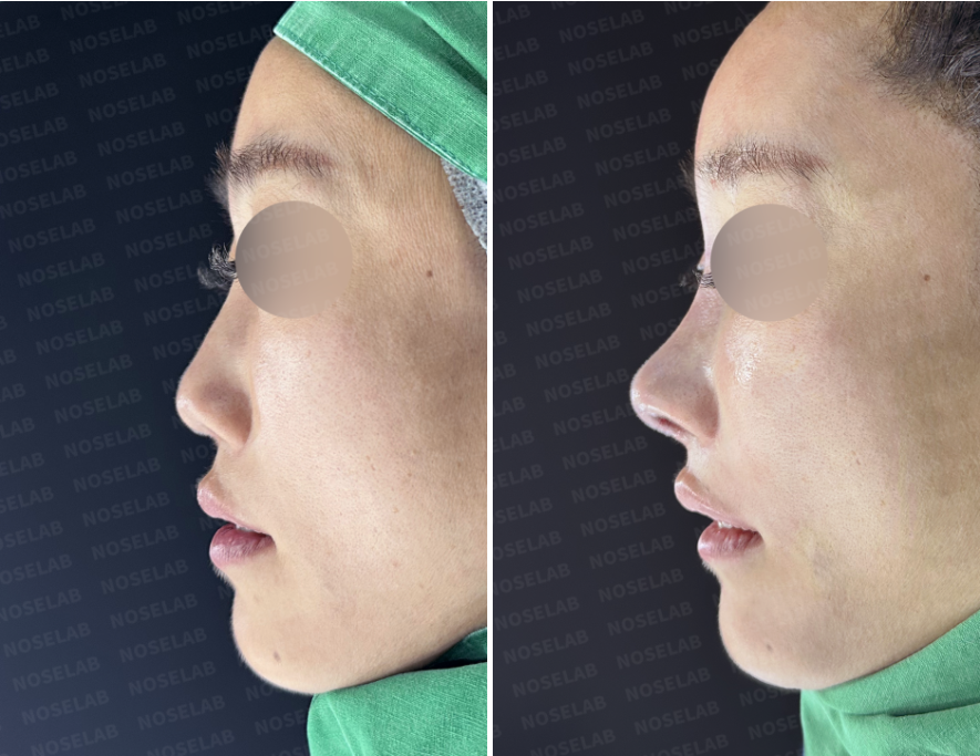 Side view comparison before and after illegal filler removal and septal reconstruction using autologous rib cartilage — left: before surgery, right: immediately after surgery.