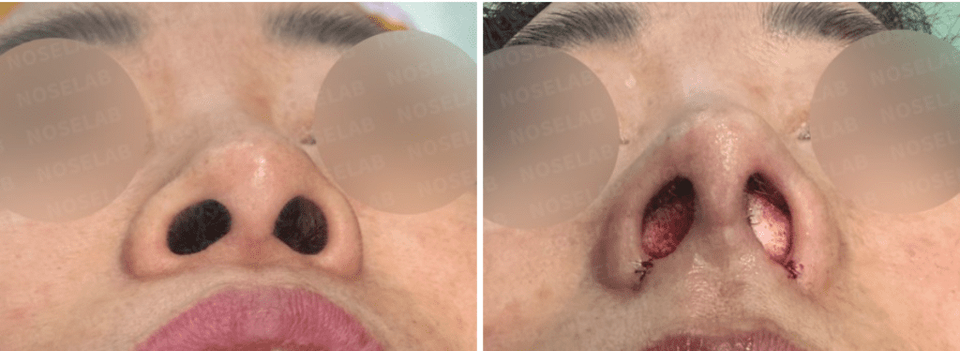 Before surgery (left), after surgery (right)