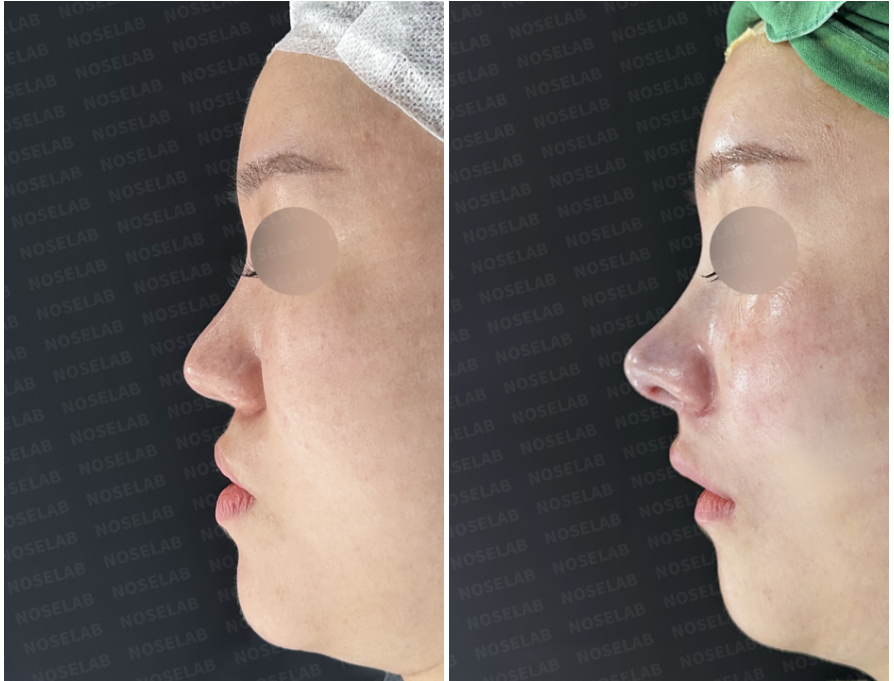 Before and immediately after surgery lateral view showing restoration of columellar projection and improved nasal tip contour following revision closed rhinoplasty with autologous rib cartilage reconstruction.