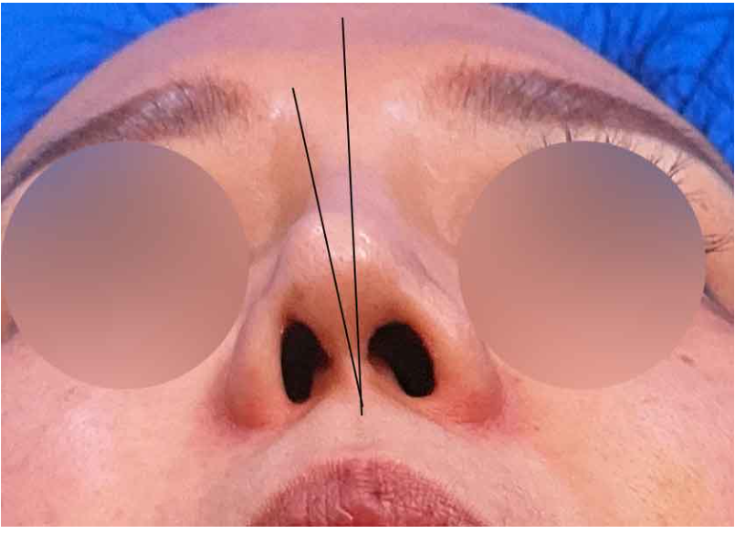 Nasal base preoperative design photo showing asymmetric nostrils, columella tilted to the right, and thin columella before nose bridge starting point lowering and glabella correction surgery.